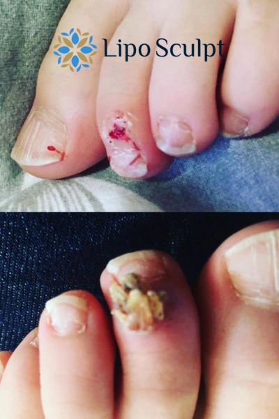 Wart removal customer results from Lipo Sculpt Headingley